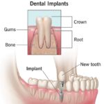 Dental implant treatment by Dr. Nilam at Tooth Care Dental Clinic in Nizampura – restoring missing teeth with permanent solutions
