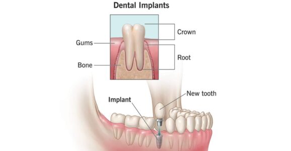 Dental implant treatment by Dr. Nilam at Tooth Care Dental Clinic in Nizampura – restoring missing teeth with permanent solutions