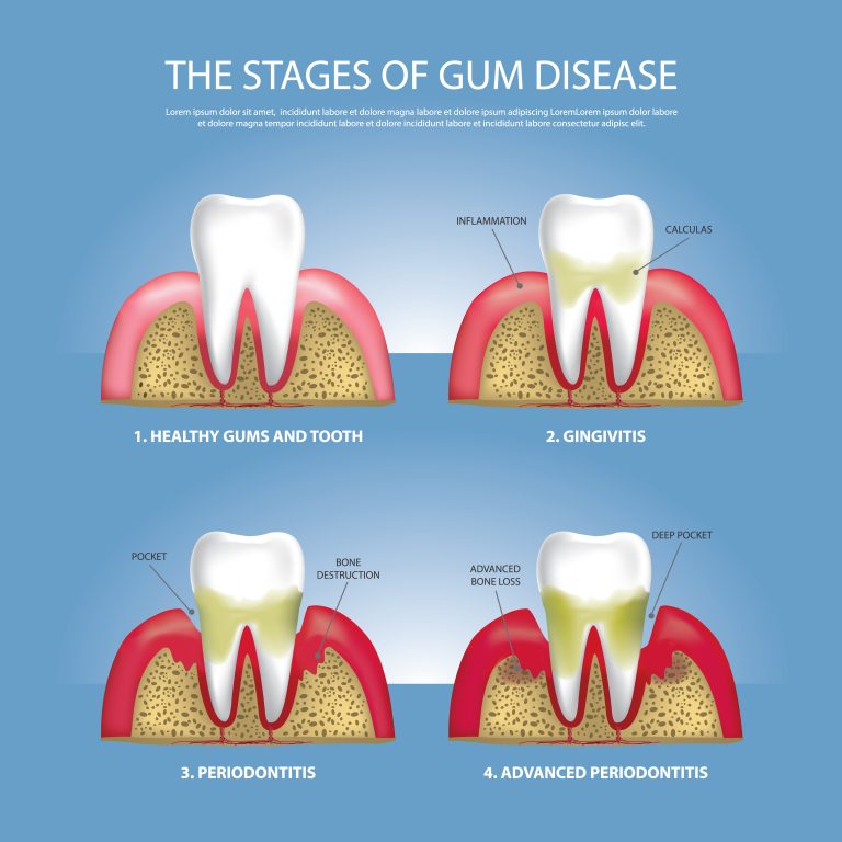 Gum disease treatment by Dr. Nilam Dhameliya at Tooth Care Dental Clinic in Nizampura”